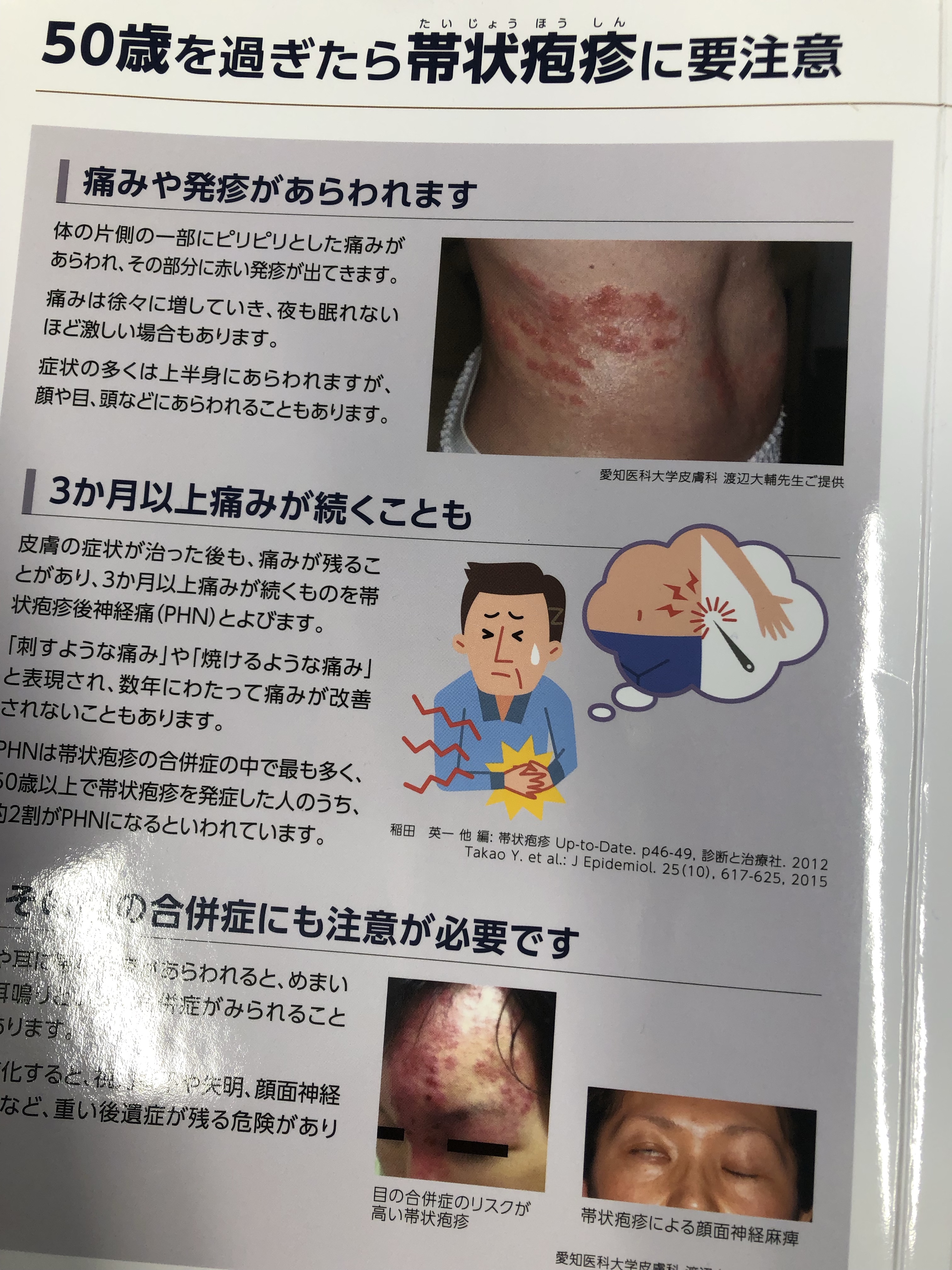 掌蹠膿疱症性骨関節炎 （SAPHO症候群）足裏や手掌に皮膚疹を伴う